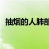 抽煙的人肺部x光（抽煙后的肺部x光圖片）