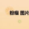 粉瘤 圖片（粉瘤是什么樣子的圖片）