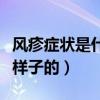 風(fēng)疹癥狀是什么樣子的圖片（風(fēng)疹癥狀是什么樣子的）
