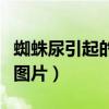 蜘蛛尿引起的水泡圖片集（蜘蛛尿引起的水泡圖片）