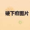 硬下疳圖片 自我鑒定（硬下鉗初期照片）