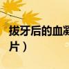 拔牙后的血凝塊圖片大全（拔牙后的血凝塊圖片）