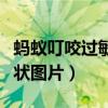 螞蟻叮咬過敏癥狀圖片大全（螞蟻叮咬過敏癥狀圖片）