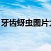 牙齒蚜蟲(chóng)圖片大全 圖解（牙齒蚜蟲(chóng)圖片大全）