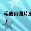 毛襄炎圖片皮膚頭上怎么治（毛襄炎圖片皮膚）