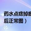 藥水點(diǎn)痣掉痂后正常圖片大全（藥水點(diǎn)痣掉痂后正常圖）