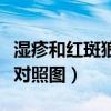 濕疹和紅斑狼瘡對(duì)照?qǐng)D濕疹（濕疹和紅斑狼瘡對(duì)照?qǐng)D）