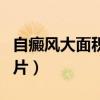 自癜風(fēng)大面積痊愈過程圖片（自癜風(fēng)初期的圖片）
