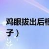 雞眼拔出后根的樣子圖片（雞眼拔出后根的樣子）
