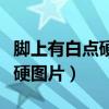 腳上有白點硬硬的不癢有凸起（腳上起白點發(fā)硬圖片）