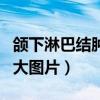 頜下淋巴結(jié)腫大疼是怎么回事（下頜淋巴結(jié)腫大圖片）