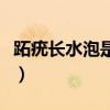 跖疣長水泡是什么樣的（跖疣初期小泡泡圖片）