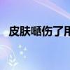 皮膚嗮傷了用什么藥（皮膚嗮傷了怎么辦）