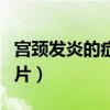 宮頸發(fā)炎的癥狀圖片大全（宮頸發(fā)炎的癥狀圖片）
