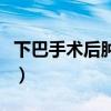 下巴手術(shù)后腫脹淤青怎么快速消除（下巴手術(shù)）
